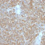 FFPE human melanoma sections stained with 100 ul anti-Bcl-2 (clone BCL2/782 + BCL2/796) at 1:50. HIER epitope retrieval prior to staining was performed in 10mM Tris 1mM EDTA, pH 9.0.